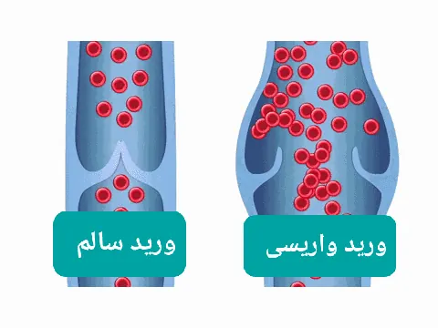 سونوگرافی داپلر و مشاوره واریس